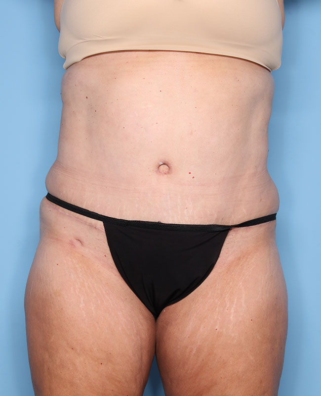 Case--30224 | After Abdominoplasty