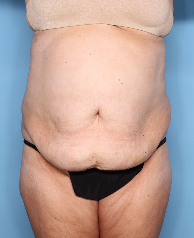 Case--30224 | Before Abdominoplasty