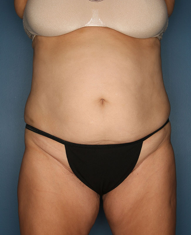 Case--30124 | Before Abdominoplasty