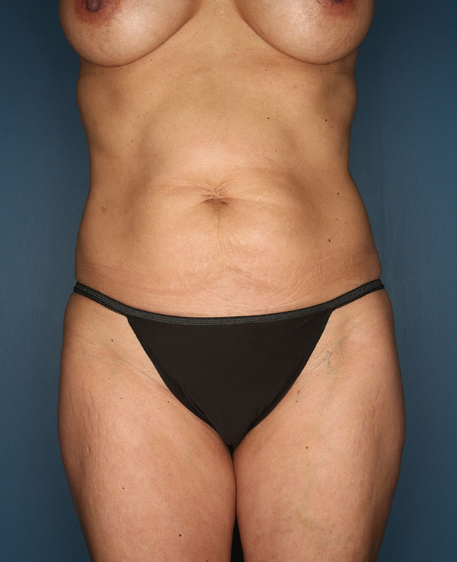 Case--29924 | Before Abdominoplasty
