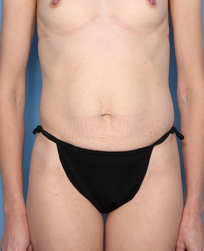 Case--29724 | Before Abdominoplasty