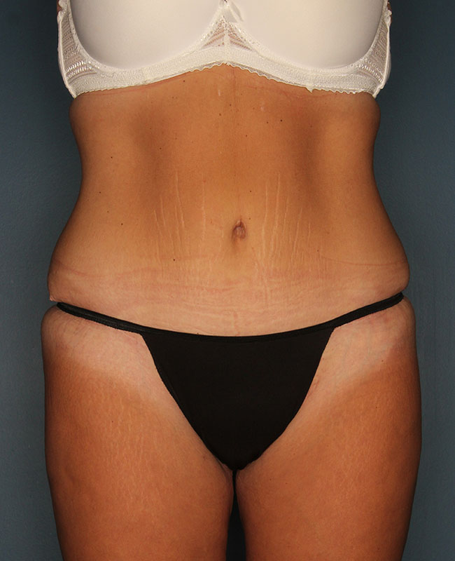 Case--29624 | After Abdominoplasty