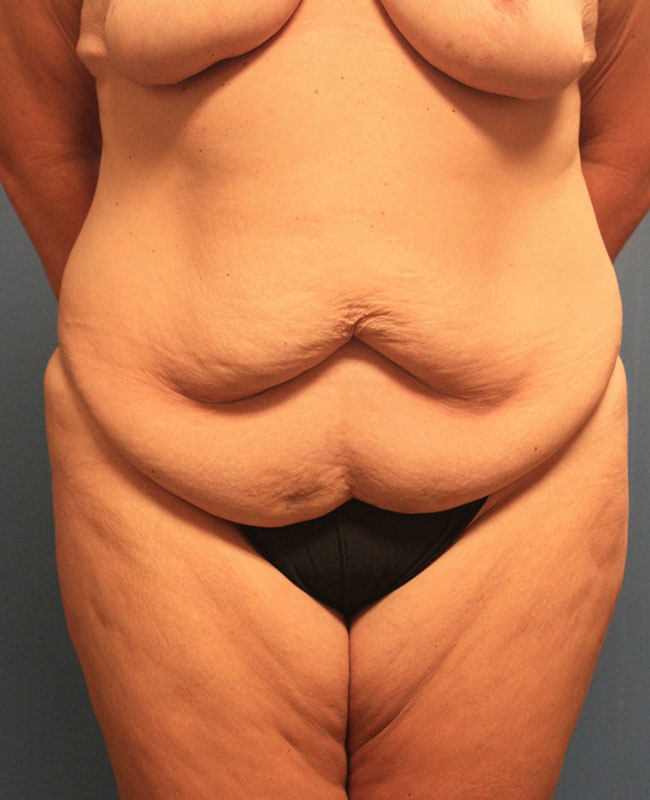 Case--29624 | Before Abdominoplasty