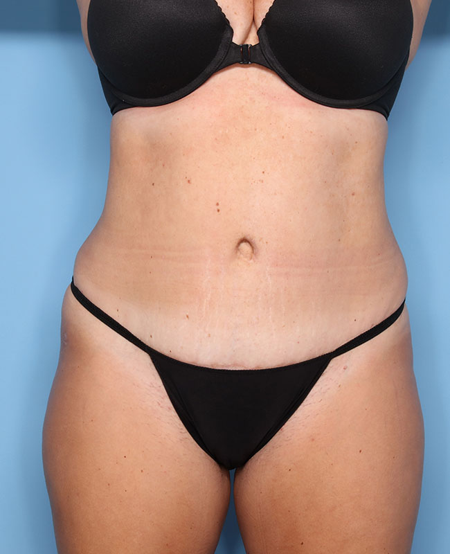 Case--29524 | After Abdominoplasty