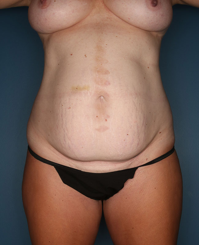 Case--29524 | Before Abdominoplasty