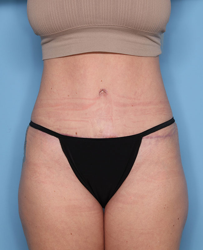 Case--29324 | After Abdominoplasty