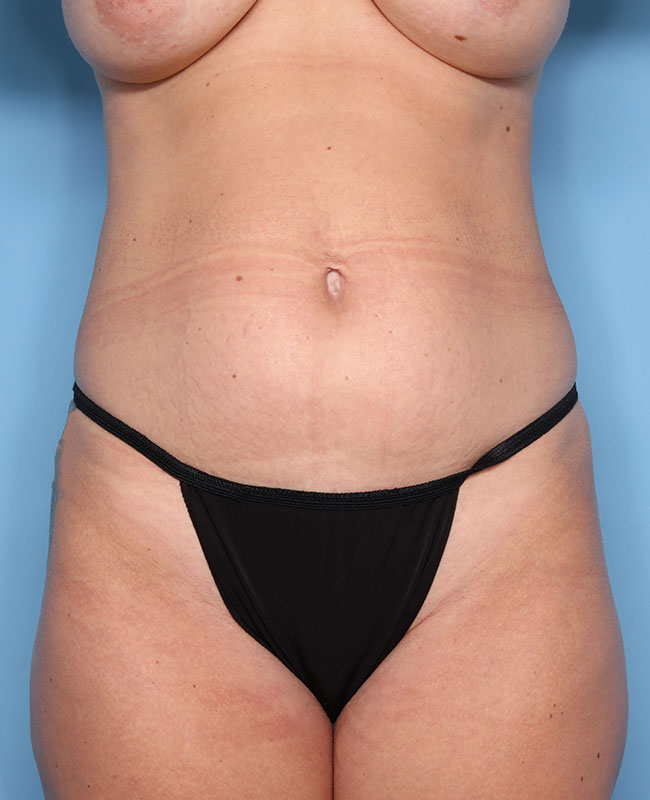Case--29324 | Before Abdominoplasty