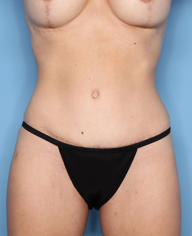 Case--29024 | After Abdominoplasty