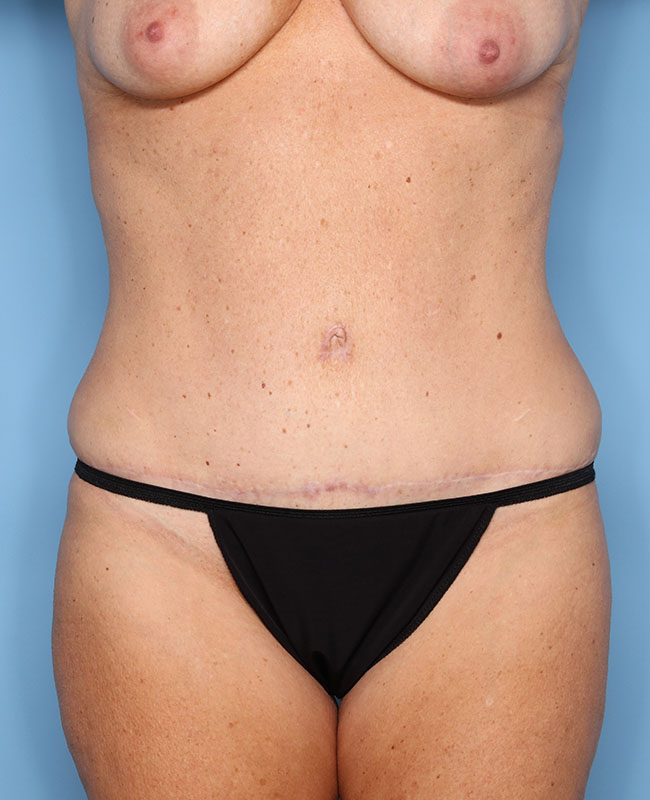 Case--28924 | After Abdominoplasty
