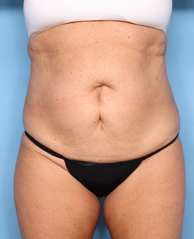 Case--28924 | Before Abdominoplasty
