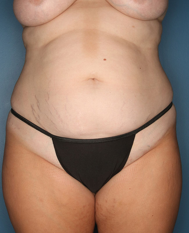 Case--28824 | Before Abdominoplasty