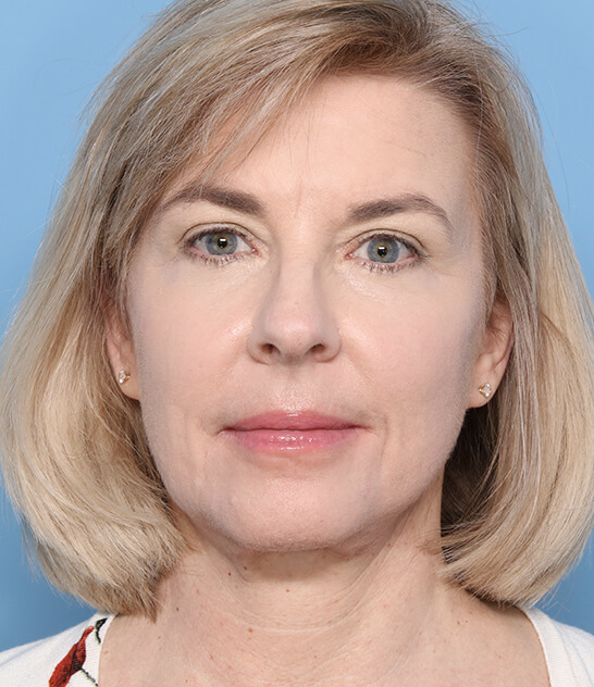 Case--1022 | After Facelift