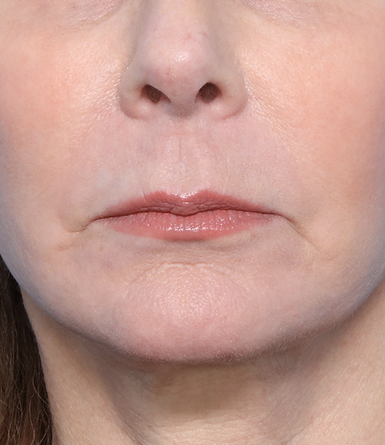 Case--1522 | After Facelift