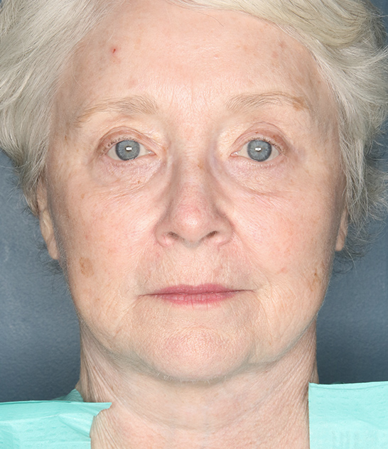 Case--2922 | After Facelift