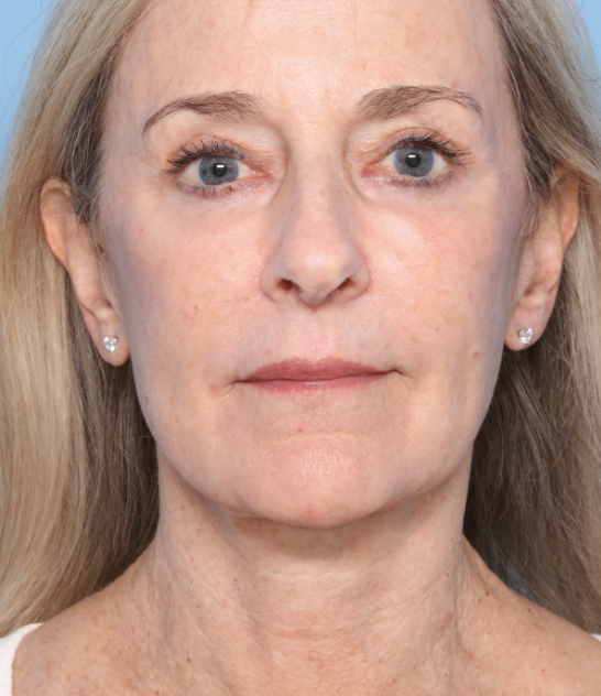 Case--3022 | After Facelift