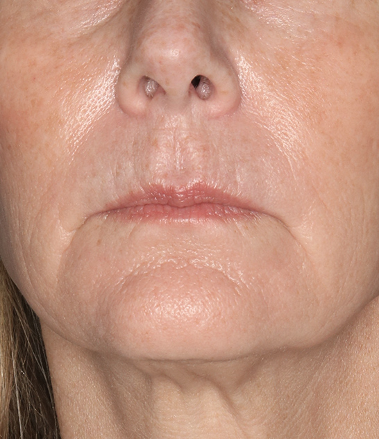 Case--1522 | Before Facelift