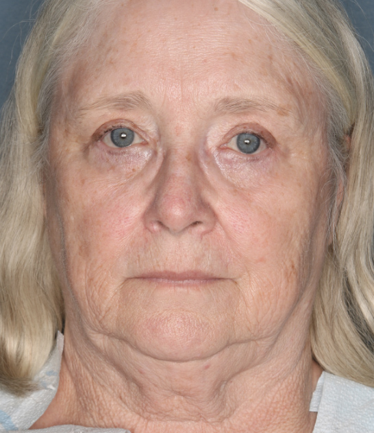 Case--2922 | Before Facelift