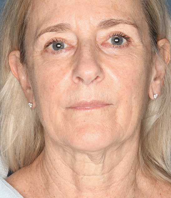 Case--3022 | Before Facelift