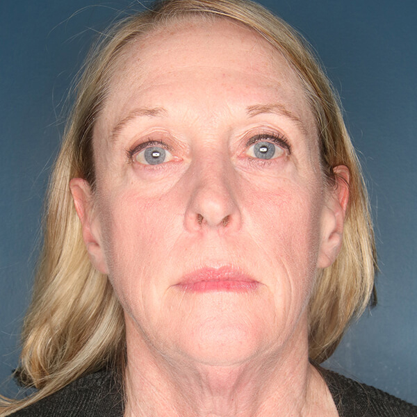 Patient-3120 | Before Facelift