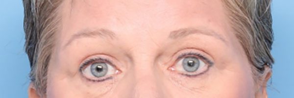 Case--7123 | After Face