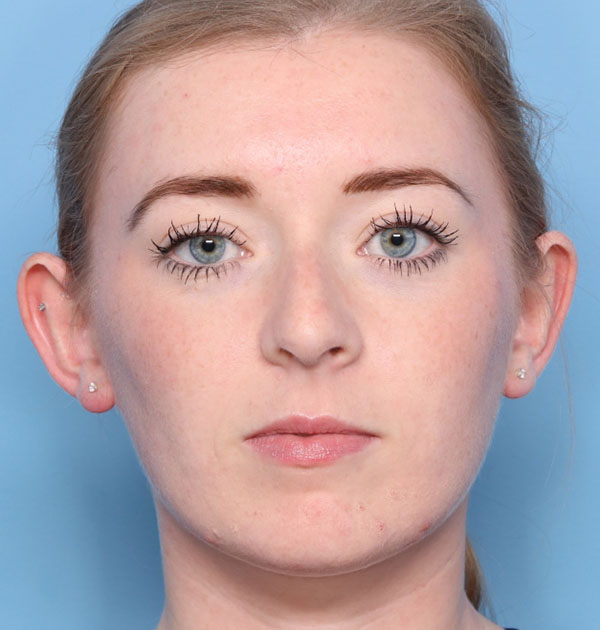 Case--8023 | Before Face