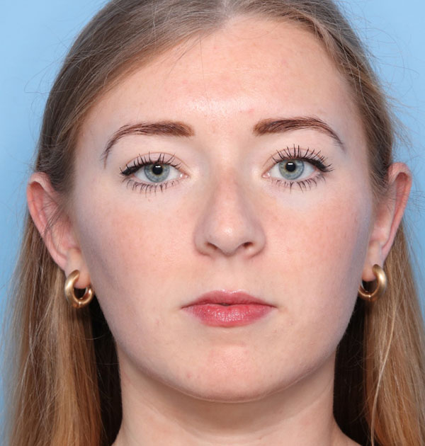 Case--8023 | After Face